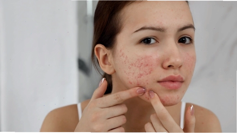BHA có khả năng hỗ trợ làm mờ vết thâm mụn