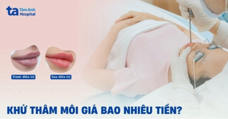 Hình ảnh minh họa chi phí khử thâm môi