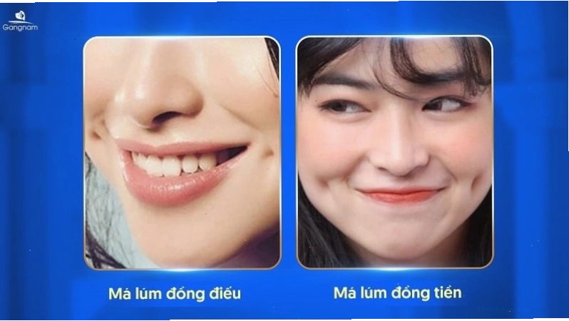 Hình ảnh minh họa má lúm đồng điếu trên khuôn mặt