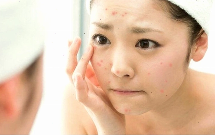 Làm sạch da mụn đầu đen hàng ngày với nước ấm và sữa rửa mặt dịu nhẹ