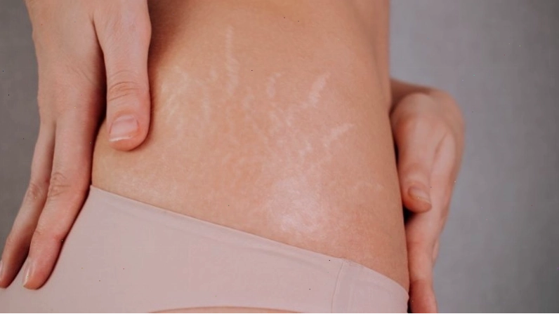 Retinol có thể hỗ trợ làm mờ vết rạn da